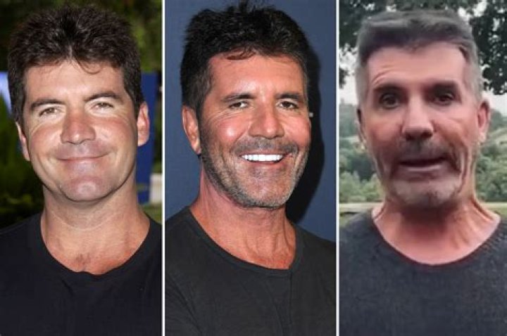 Simon Cowell's Transformation: A Look At His Before And After Plastic Surgery